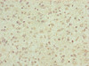 Immunohistochemistry of paraffin-embedded human glioma using CSB-PA873634ESR1HU at dilution of 1:100