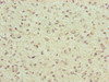 Immunohistochemistry of paraffin-embedded human glioma using CSB-PA873634ESR2HU at dilution of 1:100