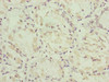 Immunohistochemistry of paraffin-embedded human gastric cancer using CSB-PA883413ESR1HU at dilution of 1:100