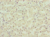 Immunohistochemistry of paraffin-embedded human gastric cancer using CSB-PA883413ESR2HU at dilution of 1:100