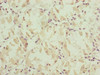 Immunohistochemistry of paraffin-embedded human gastric cancer using CSB-PA015665DSR2HU at dilution of 1:100