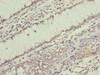 Immunohistochemistry of paraffin-embedded human colon cancer using CSB-PA019816ESR1HU at dilution of 1:100