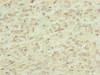 Immunohistochemistry of paraffin-embedded human glioma using CSB-PA019831DSR2HU at dilution of 1:100