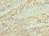 Immunohistochemistry of paraffin-embedded human gastric cancer using CSB-PA811599ESR1HU at dilution of 1:100