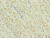 Immunohistochemistry of paraffin-embedded human gastric cancer using CSB-PA811599ESR2HU at dilution of 1:100