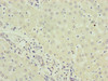 Immunohistochemistry of paraffin-embedded human liver cancer using CSB-PA857879DSR1HU at dilution of 1:100