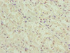 Immunohistochemistry of paraffin-embedded human gastric cancer using CSB-PA857879DSR1HU at dilution of 1:100