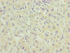 Immunohistochemistry of paraffin-embedded human liver cancer using CSB-PA857879DSR2HU at dilution of 1:100