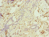 Immunohistochemistry of paraffin-embedded human breast cancer using CSB-PA871394ESR2HU at dilution of 1:100