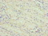 Immunohistochemistry of paraffin-embedded human gastric cancer using CSB-PA024459ESR1HU at dilution of 1:100