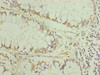 Immunohistochemistry of paraffin-embedded human colon cancer using CSB-PA883650ESR1HU at dilution of 1:100