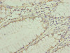 Immunohistochemistry of paraffin-embedded human colon cancer using CSB-PA883650ESR2HU at dilution of 1:100