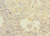 Immunohistochemistry of paraffin-embedded human lung cancer using CSB-PA010125ESR2HU at dilution of 1:100