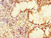 Immunohistochemistry of paraffin-embedded human colon cancer using CSB-PA880972ESR1HU at dilution of 1:100