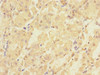 Immunohistochemistry of paraffin-embedded human gastric cancer using CSB-PA018238ESR2HU at dilution of 1:100