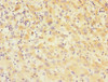 Immunohistochemistry of paraffin-embedded human lung cancer using CSB-PA735951ESR1HU at dilution of 1:100