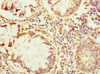 Immunohistochemistry of paraffin-embedded human colon cancer using CSB-PA027120ESR1HU at dilution of 1:100