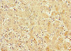 Immunohistochemistry of paraffin-embedded human liver cancer using CSB-PA822270ESR2HU at dilution of 1:100