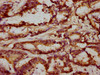 IHC image of CSB-PA822270ESR2HU diluted at 1:293 and staining in paraffin-embedded human colon cancer performed on a Leica BondTM system. After dewaxing and hydration, antigen retrieval was mediated by high pressure in a citrate buffer (pH 6.0) . Section was blocked with 10% normal goat serum 30min at RT. Then primary antibody (1% BSA) was incubated at 4°C overnight. The primary is detected by a biotinylated secondary antibody and visualized using an HRP conjugated SP system.