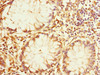Immunohistochemistry of paraffin-embedded human colon cancer using CSB-PA771447ESR1HU at dilution of 1:100