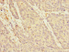 Immunohistochemistry of paraffin-embedded human ovarian cancer using CSB-PA771447ESR1HU at dilution of 1:100