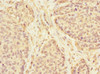 Immunohistochemistry of paraffin-embedded human ovarian cancer using CSB-PA865211ESR1HU at dilution of 1:100