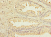 Immunohistochemistry of paraffin-embedded human prostate cancer using CSB-PA865211ESR1HU at dilution of 1:100