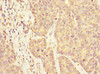 Immunohistochemistry of paraffin-embedded human ovarian cancer using CSB-PA865211ESR2HU at dilution of 1:100