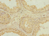 Immunohistochemistry of paraffin-embedded human prostate cancer using CSB-PA865211ESR2HU at dilution of 1:100