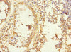 Immunohistochemistry of paraffin-embedded human colon cancer using CSB-PA896500ESR1HU at dilution of 1:100