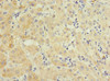 Immunohistochemistry of paraffin-embedded human liver cancer using CSB-PA847618ESR1HU at dilution of 1:100