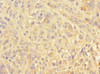 Immunohistochemistry of paraffin-embedded human melanoma using CSB-PA847618ESR1HU at dilution of 1:100