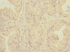 Immunohistochemistry of paraffin-embedded human prostate cancer using CSB-PA882076ESR2HU at dilution of 1:100