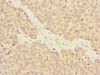 Immunohistochemistry of paraffin-embedded human ovarian cancer using CSB-PA019349ESR2HU at dilution of 1:100