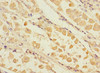 Immunohistochemistry of paraffin-embedded human gastric cancer using CSB-PA822281ESR1HU at dilution of 1:100