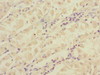 Immunohistochemistry of paraffin-embedded human gastric cancer using CSB-PA822281ESR2HU at dilution of 1:100