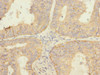 Immunohistochemistry of paraffin-embedded human endometrial cancer using CSB-PA875672ESR1HU at dilution of 1:100