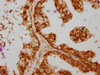 IHC image of CSB-PA875672ESR1HU diluted at 1:364 and staining in paraffin-embedded human prostate cancer performed on a Leica BondTM system. After dewaxing and hydration, antigen retrieval was mediated by high pressure in a citrate buffer (pH 6.0) . Section was blocked with 10% normal goat serum 30min at RT. Then primary antibody (1% BSA) was incubated at 4°C overnight. The primary is detected by a biotinylated secondary antibody and visualized using an HRP conjugated SP system.