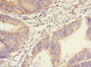 Immunohistochemistry of paraffin-embedded human endometrial cancer using CSB-PA875672ESR2HU at dilution of 1:100