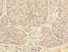 Immunohistochemistry of paraffin-embedded human ovarian cancer using CSB-PA024108ESR2HU at dilution of 1:100 Immunohistochemistry of paraffin-embedded human ovarian cancer using CSB-PA024108ESR2HU at dilution of 1:100