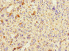 Immunohistochemistry of paraffin-embedded human melanoma using CSB-PA617924ESR2HU at dilution of 1:100