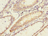 Immunohistochemistry of paraffin-embedded human colon cancer using CSB-PA822782ESR1HU at dilution of 1:100
