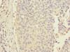 Immunohistochemistry of paraffin-embedded human cervical cancer using CSB-PA004453DSR1HU at dilution of 1:100