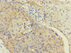 Immunohistochemistry of paraffin-embedded human cervical cancer using CSB-PA004453DSR2HU at dilution of 1:100
