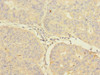 Immunohistochemistry of paraffin-embedded human endometrial cancer using CSB-PA773051DSR1HU at dilution of 1:100