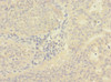 Immunohistochemistry of paraffin-embedded human endometrial cancer using CSB-PA773051DSR2HU at dilution of 1:100