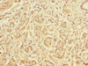 Immunohistochemistry of paraffin-embedded human pancreatic cancer using CSB-PA006891ESR1HU at dilution of 1:100