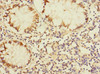 Immunohistochemistry of paraffin-embedded human colon cancer using CSB-PA887158ESR1HU at dilution of 1:100