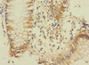 Immunohistochemistry of paraffin-embedded human colon cancer using CSB-PA887158ESR2HU at dilution of 1:100