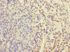 Immunohistochemistry of paraffin-embedded human bladder cancer using CSB-PA007558ESR1HU at dilution of 1:100